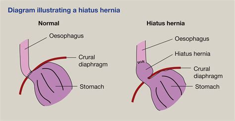 Gastro Oesophageal Reflux Disease And Hiatus Hernia Medicine