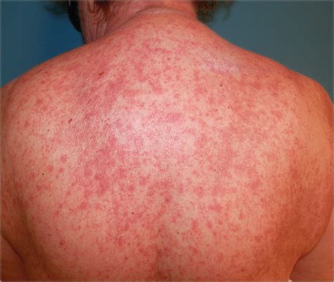 Subacute Cutaneous Lupus Erythematosus Induced By Mitotane
