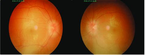 Fundus Examination Showed Bilateral Optic Disc Swelling Download