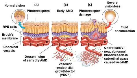 Age Related Macular Degeneration Amd A Review On Its Epidemiology
