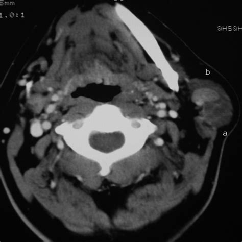 Warthins Tumors Of Parotid Glands Eurorad