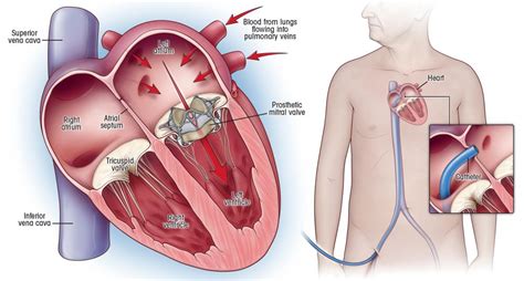 A Remarkable Technique To Replace Heart Valves Spares Patients Surgery