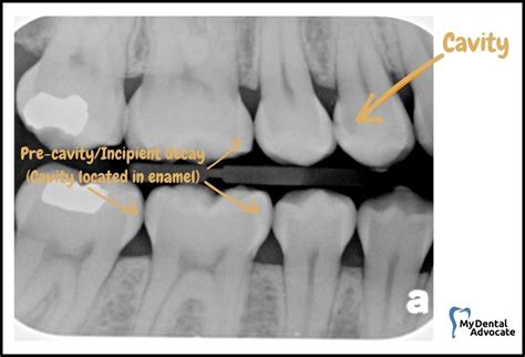 🦷 What Does A Cavity Look Like 20 Pictures Mda