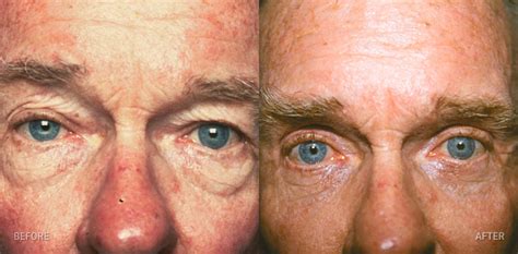 Blepharoplasty The Pinch Men Patient 1 Lorne K Rosenfield