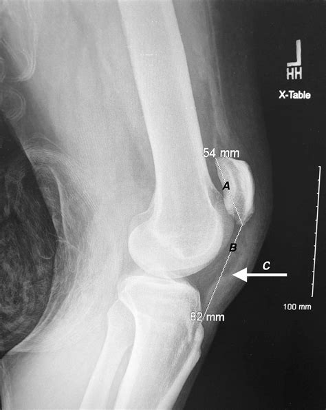 Patellar Tendon Rupture