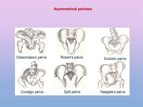 Abnormalities Of Bony Pelvis Online Presentation