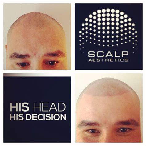 Pin On Scalp Micropigmentation