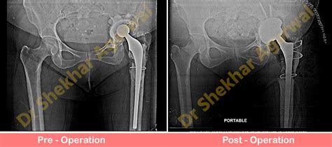 Re Revision Total Hip Replacement Sant Parmanand Hospital