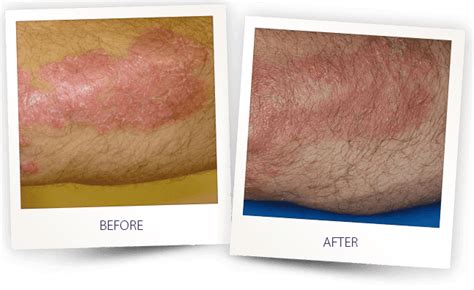 Psoriasis Laser Treatment Focused Uvb Light Therapy