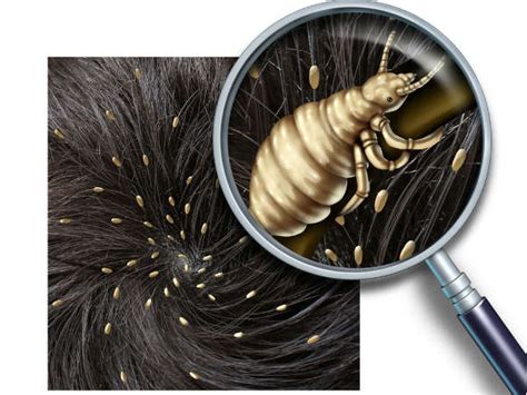 Head Lice How Do They Spread Symptoms Treatment And Prevention