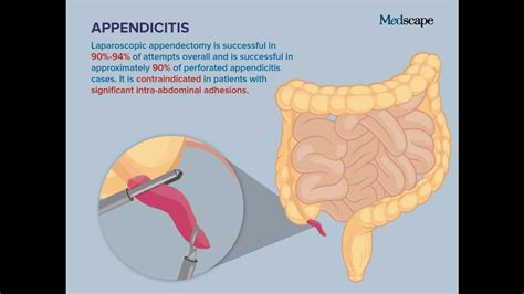 3 Year Old Appendicitis Stomachaches For Kids Nemours Kidshealth