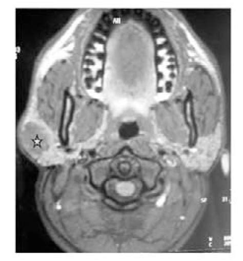 Parotid Mri Axial T1 Weighted Section Showing Right Parotid Lesion In