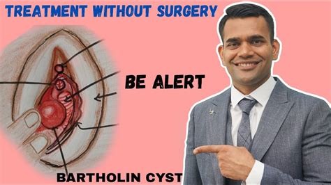 Bartholin Cyst Treatment Without Surgery Bartholin Cyst Different