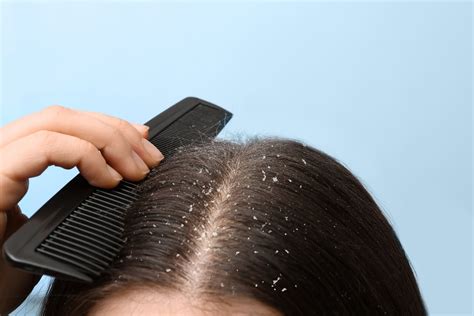 Types Of Dandruff And How To Prevent Them Head And Shoulders In