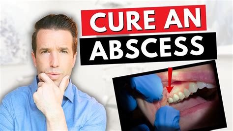 Dentist Explains A Tooth Abscess How To Cure An Abscess Tooth Youtube