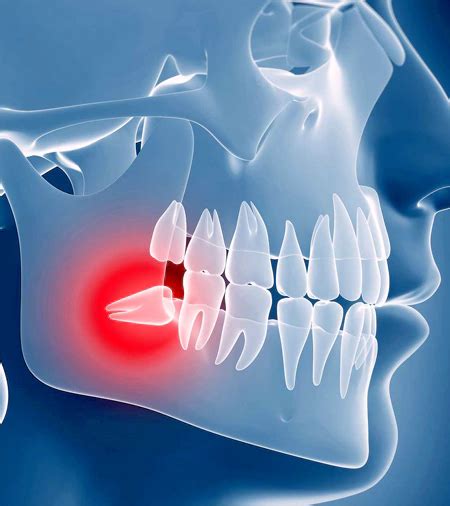 Jaw Cyst Tumor Surgery Fms Dental Hospital