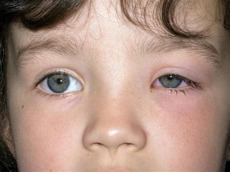 Periorbital Preseptal Cellulitis Swelling Under One Eye Babycenter