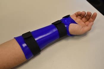Distal Radius Fracture Sportsperformance Physiotherapy