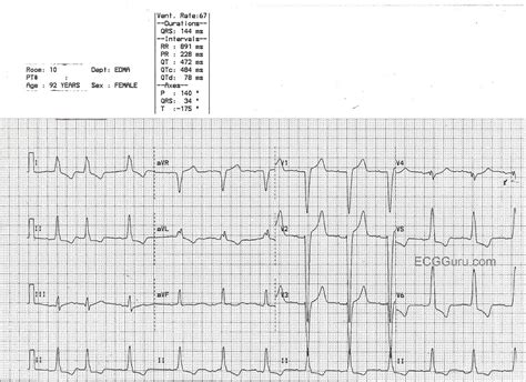 Left Bundle Branch Block And Left Ventricular Hypertrophy Ecg Porn Sex Picture