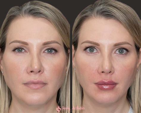 Lip Filler Before And After Results Skinly Aesthetics