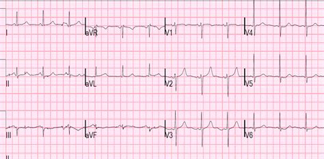 Dr. Smith's ECG Blog: A 50-something with severe chest pain and a ...