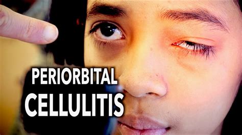 Periorbital Cellulitis Painful Dr Paul Youtube