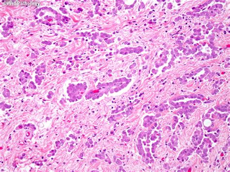 Higher magnification shows psammoma bodies closely admixed with neoplastic cells. Webpathology.com: A Collection of Surgical Pathology Images