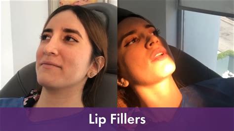 You can also drag files to the drop area to start uploading. Fillers Labios / Aumento De Labios Sin Cirugia Conoce Todo ...