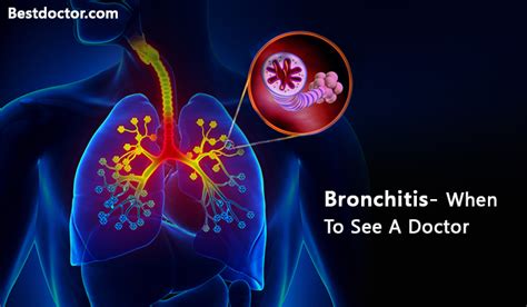 bronchitis when to see a doctor