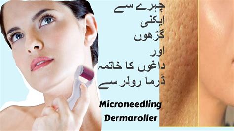 Dermaroller To Remove Acnescarswrinkles Overview Microneedling Urdu