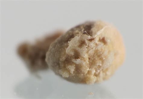 Picture Of 4mm Kidney Stone کامل مولیزی