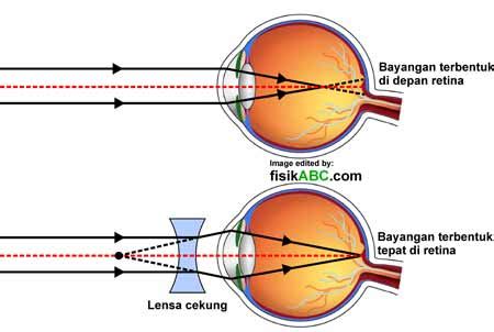 Jenis Cacat Mata Dan Lensa Kacamata Yang Dibutuhkan Gambar Rumus