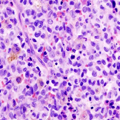 Eosinophilic Granuloma Histology Image