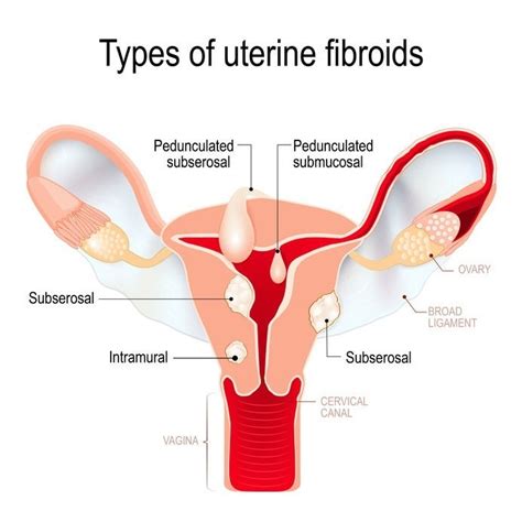 Types Of Uterine Fibroids Things You Need To Know
