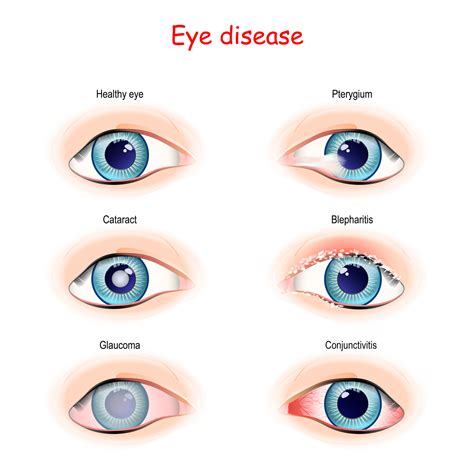 What Is Conjunctivitis Henderson Eye Care