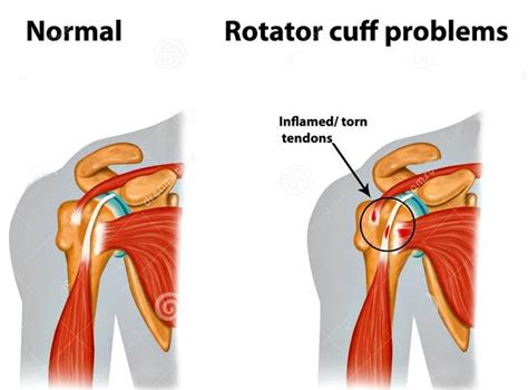 Subacromial Impingement Syndrome Pain And Weakness Of The Arm And