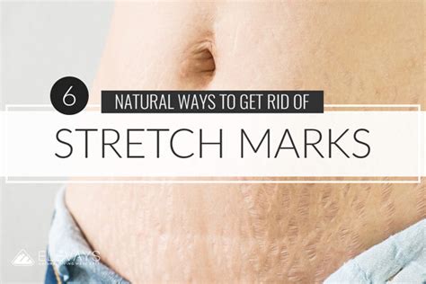 6 Natural Ways To Get Rid Of Stretch Marks Elevays