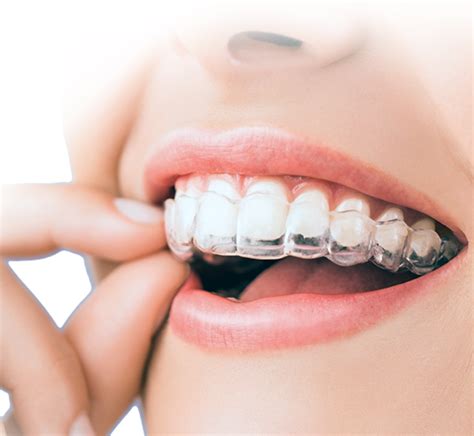 Dental braces