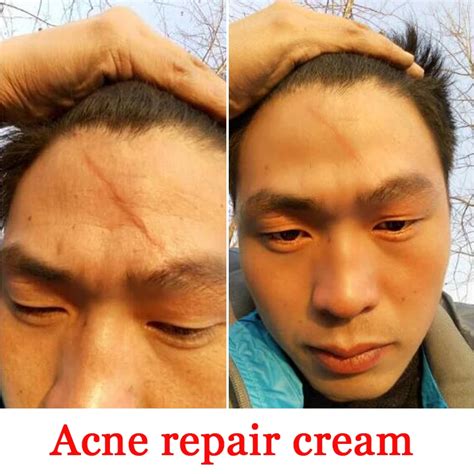 Scar Repair Skin Essential Oil Skin Care Natural Pure Remove Burn Scar
