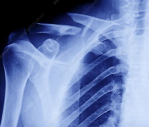 Fractured Collar Bone X Ray Stock Image M3301356 Science Photo