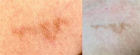 Skin Cancer Noticed It Several Months Ago Near Left Armpit On The