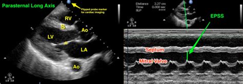 Parasternal Long Axis View With Measurement Note The Grepmed