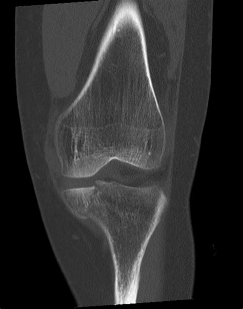 Tibial Plateau Fracture Schatzker Type Iv Image