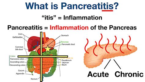 Pancreatitis Pain Symptoms Causes Treatment Diet Location