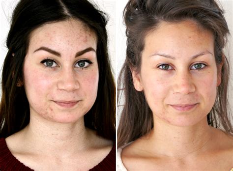 We did not find results for: Update acne behandeling bij LaserSkinClinics - Beautylab.nl