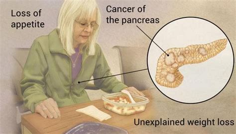 Staging Pancreatic Cancer Stage