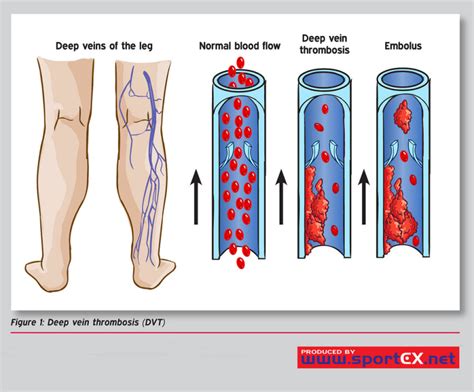 Figure Deep Vein Thrombosis Dvt Contributed By Creative Commons Cc