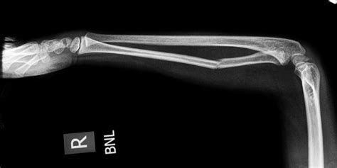 Why Do Bone Fractures Take A Long Time For Healing Biomechanics In