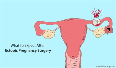 What To Expect After Ectopic Pregnancy Surgery By Dr Himanshi