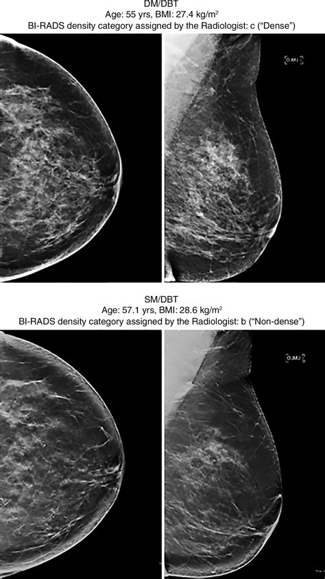 Effect Of Mammographic Screening Modality On Breast Density Assessment